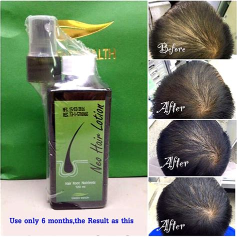 Buy Neo Hair Lotion 120ml Hair Treatment Hair Root Nutrients Pack Of 3 By Tds Online At Lowest