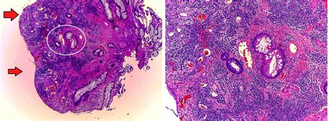 gastrointestinal and liver histology pathology atlas colon inflammatory polyp aka pseudopolyp