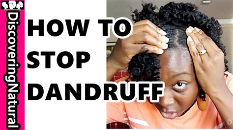 But it poofs after its been brushed. HOW TO GET RID OF DANDRUFF FAST | Dandruff Treatments for ...