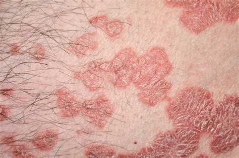 Plaque Psoriasis Stock Image C0426394 Science Photo Library