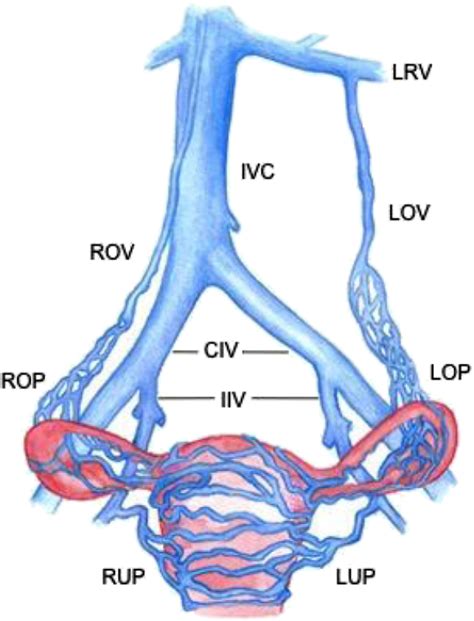 Figure 1 From Diagnosis And Treatment Of The Pelvic Congestion Syndrome