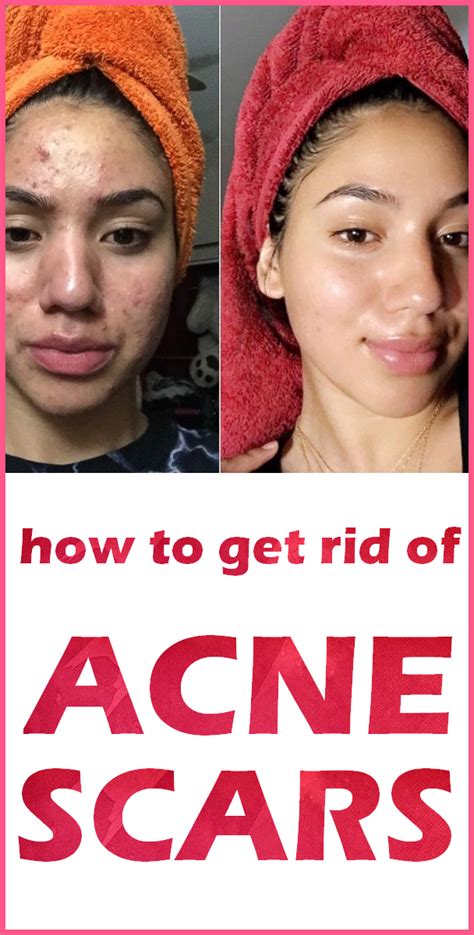 How To Use Hydrogen Peroxide For Acne Artofit