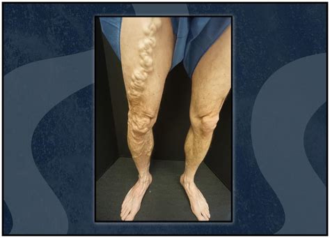 Ankle Discoloration What Is Stasis Dermatitis Veins Charlotte Blog