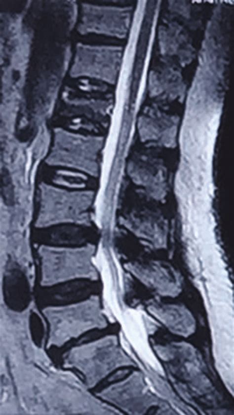 T2 Weighted Sagittal Magnetic Resonance Imaging Mri Of The Lumbar