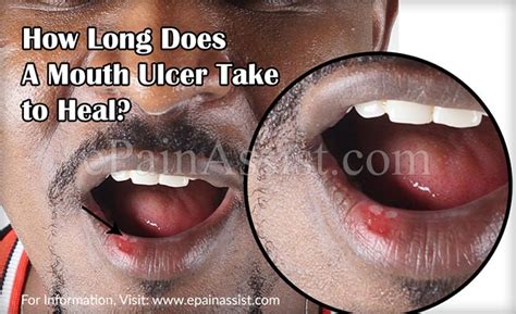 How Long Does A Mouth Ulcer Take To Heal And Best Home Remedies To Get