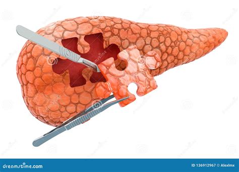 Pancreatic Surgery Concept 3d Rendering Stock Illustration