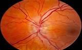 Optic Nerve Neuropathy Treatment Pictures
