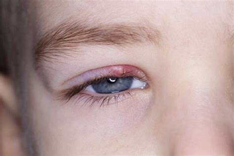 Know About The Symptoms And Causes Of Eyelid