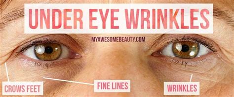How To Get Rid Of Under Eye Wrinkles Fast And Safely Under Eye