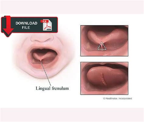 Oral Surgery Use Of Laser In Lingual Frenectomy In Pediatric Patients Odontovida