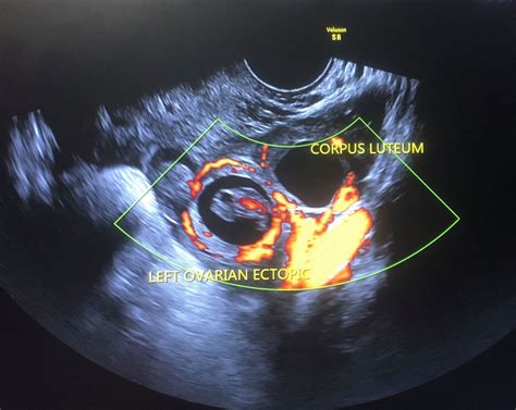 Dual Extrauterine Ectopic Pregnancy Double Management Bmj Case Reports