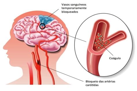 Aneurisma Cerebral Significado Aneurisma Cerebral Diagnostico Y Tratamiento Mayo Clinic