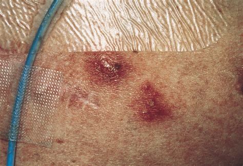 Cutaneous Aspergillosis And Acquired Immunodeficiency Syndrome Fungal