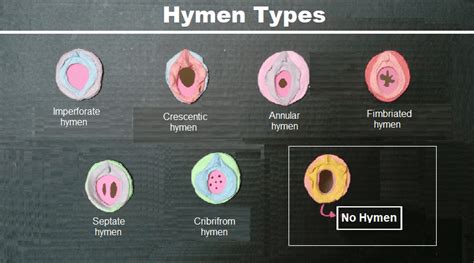 hymen types shapes and sizes archives helal medical