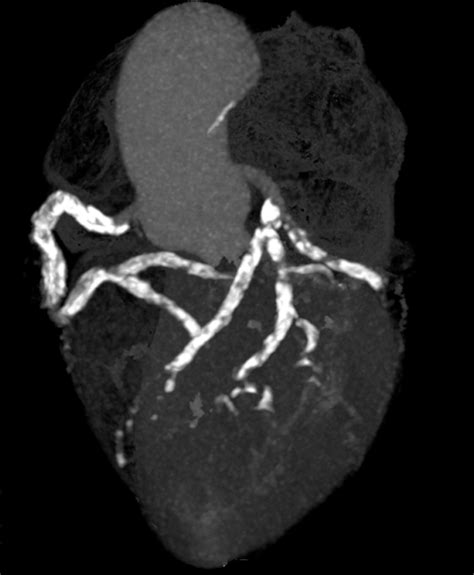 Severe Coronary Artery Calcification In A Patient With End Stage Renal