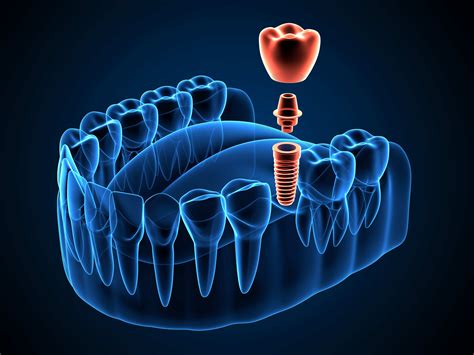 Santa Rosa Oral Surgeons Use Technology To Replace Missing Teeth