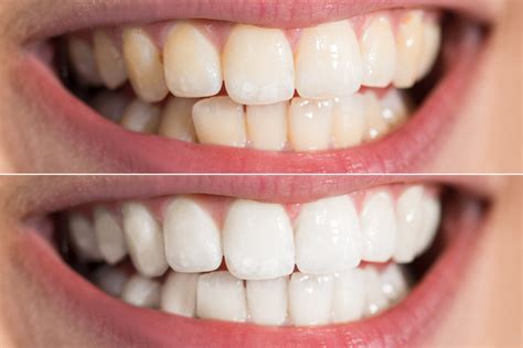 Teeth Whitening Dentist And Dental Practice Serving Evanston Area