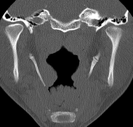 Stylohyoid Ligament Radiology Reference Article Radiopaedia Org
