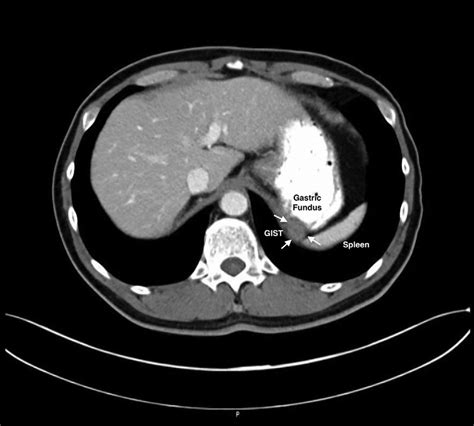 Abdominal Ct Showing 25 Cm Mural Gastrointestinal Stromal Tumor Gist