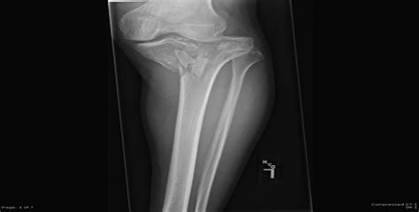 Image Quiz Tibial Plateau Fracture Jbjs Journal Of Orthopaedics For