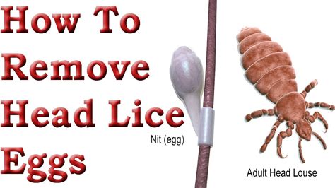 How To Remove Head Lice Eggs Head Lice Treatment Youtube
