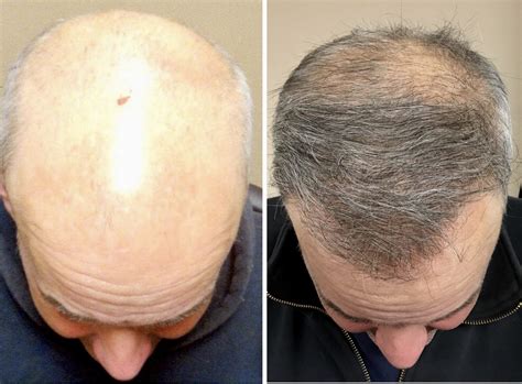 Are Hair Transplant Procedures Worth The Money 2023 Guide Webstame