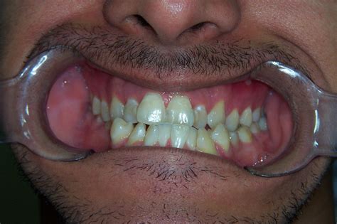 What Is The Main Cause Of Crooked Teeth Boulder Premier Dentistry