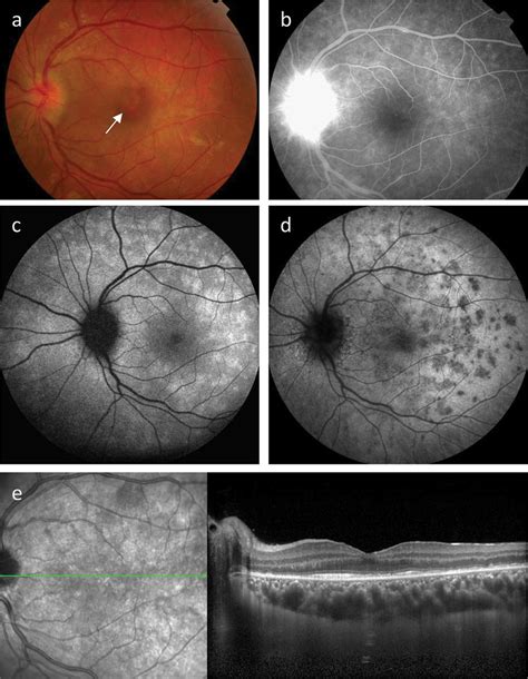 Multiple Evanescent White Dot Syndrome Clinical Course And Factors Influencing Visual Acuity