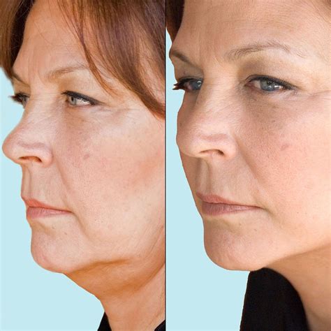 the combination of yoga facial exercises and non invasive facelifts