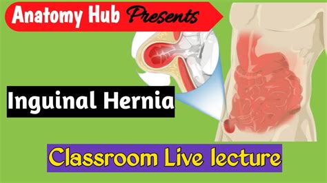 Indirect Inguinal Hernia Direct Hernia Anatomy Anatomyhub Youtube