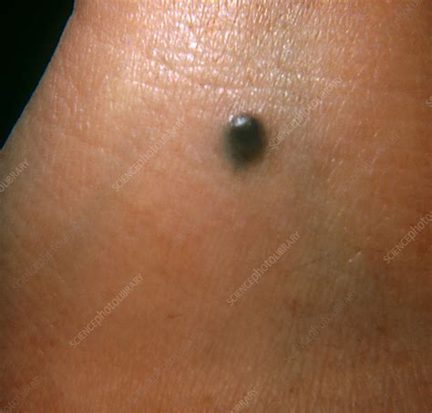 Blue Nevus Stock Image C022 2095 Science Photo Library