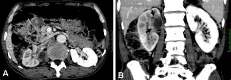 Ct Images A Axial Contrast Enhanced Nephrographic Phase Ct Image