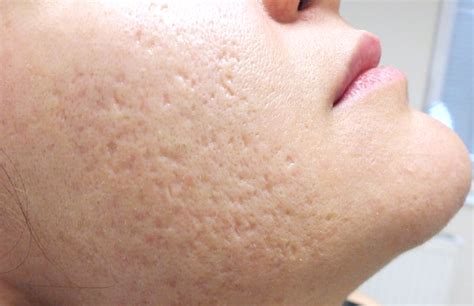Large Pores Tightening With Carbon Peel Laser Premier Clinic