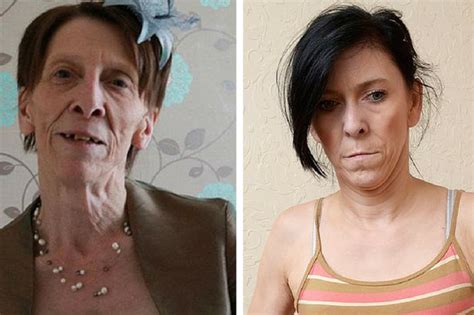 Teen Branded Granny For Looking Decades Older Has Miracle Surgery