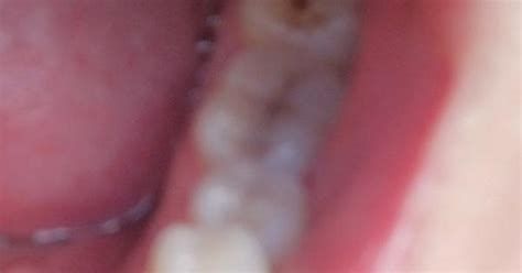 molar staining album on imgur