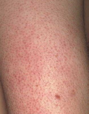 Are The Red Bumps On Your Arms Keratosis Pilaris Dorothee Padraig