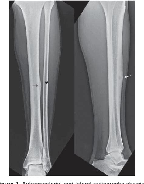 Figure 2 From Anterior Tibial Cortex Stress Fracture In A High Demand