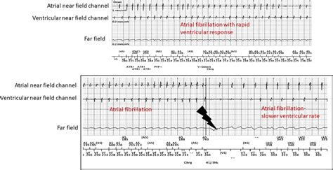 frontiers sex rhythm and death the effect of sexual activity on cardiac arrhythmias and sudden