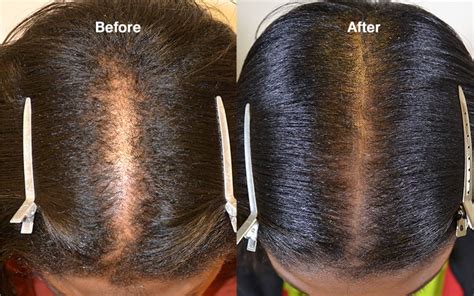 43 Black Female Hair Transplant Before And After Arunbirreshmi