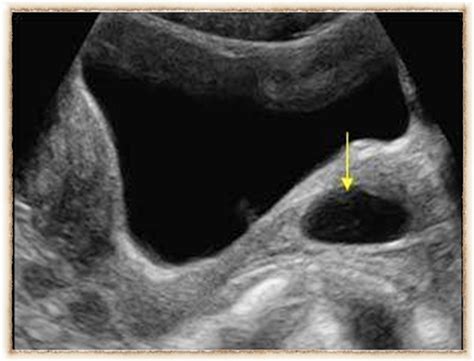 Pin On Female Pelvic Ultrasound