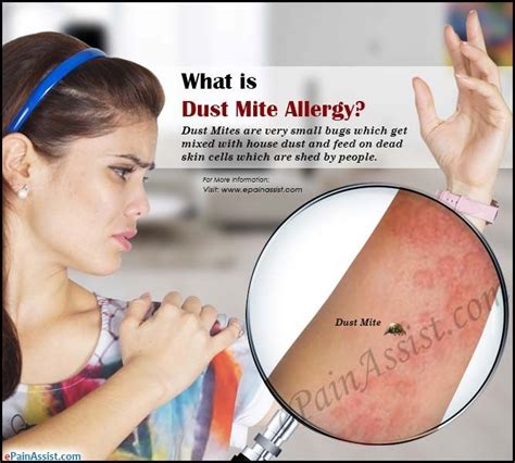 Signs You Are Allergic To Dust Dust Mite Allergy Dust Mite Allergy