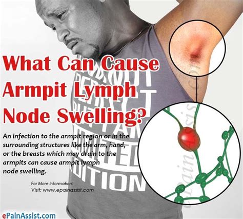 What Can Cause Armpit Lymph Node Swelling Lymph Nodes Armpit Lymph