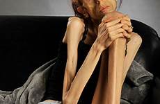farrokh anorexia woman rachael anorexic california person now after battle over who story today describes long