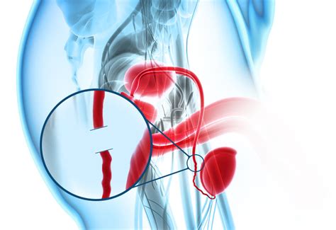Problemas, consecuencias o molestias después de una vasectomía. Vasectomia - Dr. Carlos Sacomani - Urologia especializada ...