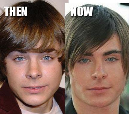Nose job is procedure that linked with zac efron. Zac Efron Nose Job Plastic Surgery Before and After