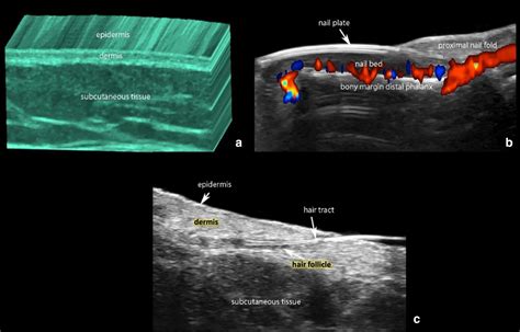 Overview Of Ultrasound Imaging Applications In Dermatology Nouf