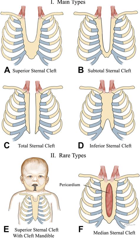 Figure 1 From Thoracic Defects Cleft Sternum And Poland Syndrome