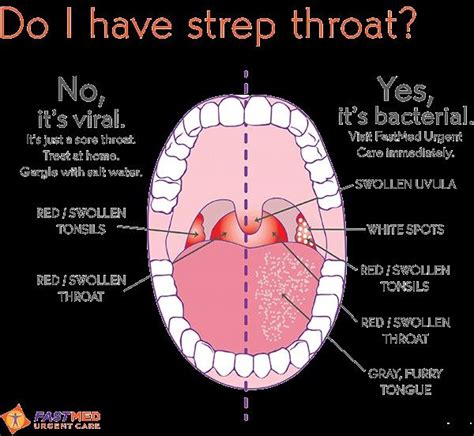 Sore Throat Swollen Uvula Sore Throat Strep Throat