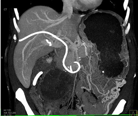 Check spelling or type a new query. Infiltrating Pancreatic Cancer - Pancreas Case Studies ...