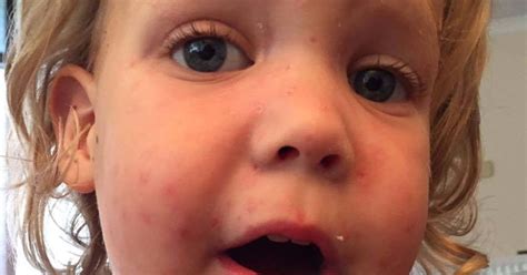 Chickenpox often starts without the classic rash, with a fever, headache, sore throat, or stomachache. Mum Whose Two-Year-Old Was Hospitalised With 'Severe ...